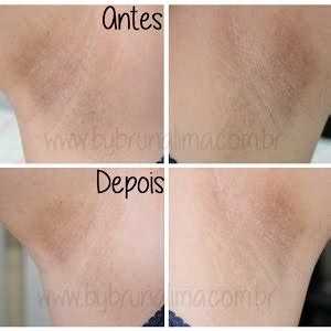 Depilação a laser virilha: confira seu antes e depois e se dói!